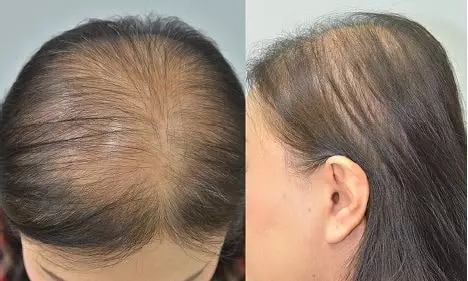 hair thining